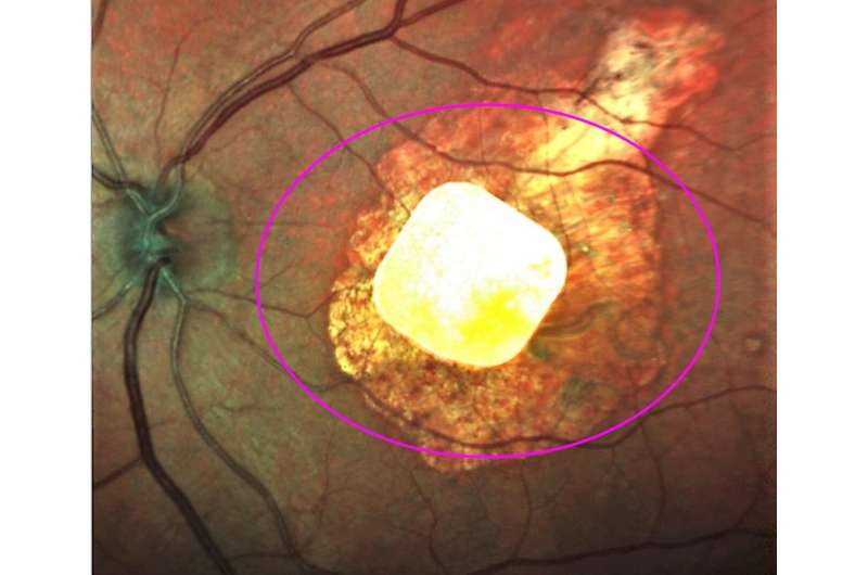 Implanted chip, natural eyesight coordinate vision in study of macular degeneration