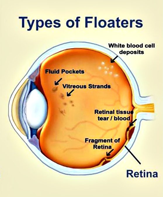 Three Must Know Facts About Eye Floaters Eye Contact